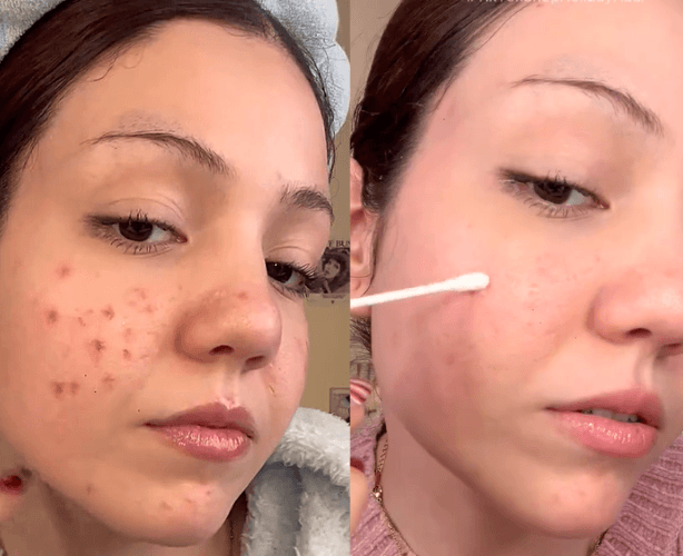 glowPure™ Acne Buster