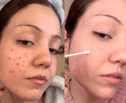 glowPure™ Acne Buster